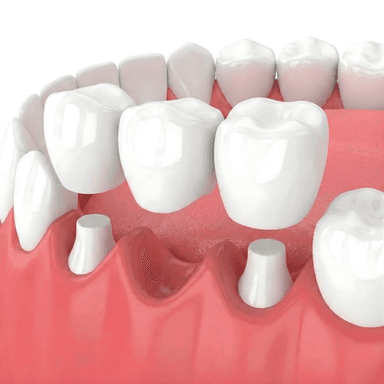 Dental Bridge