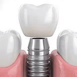 طب اللثة (دواعم الأسنان)